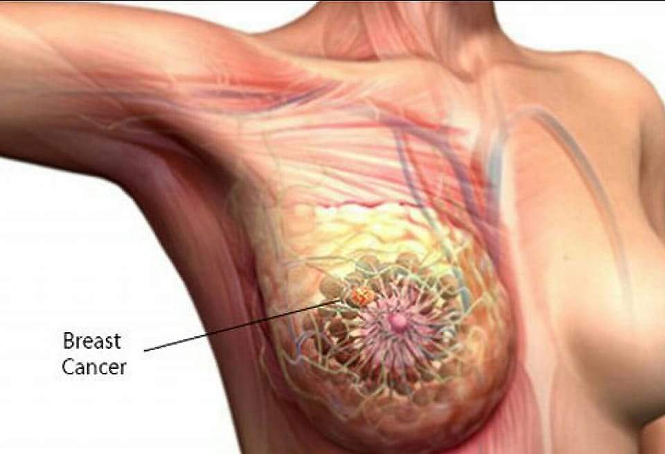 Breast Cancer Symptoms and its Remedy
