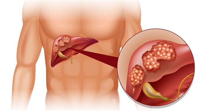 Liver Cancer Symptoms Cause and Remedy